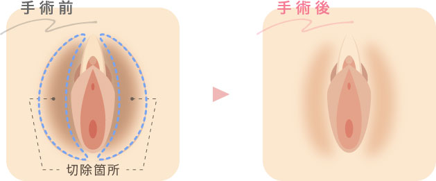 大陰唇とは？